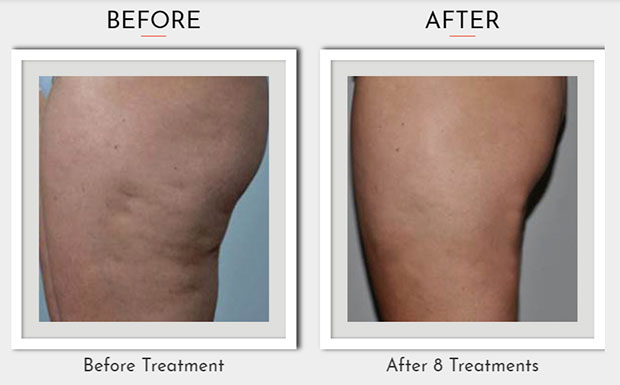 Atlantis Health Beauty And Laser Clinic Cellulite Treatment By